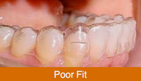 aligner poorly fitted on teeth