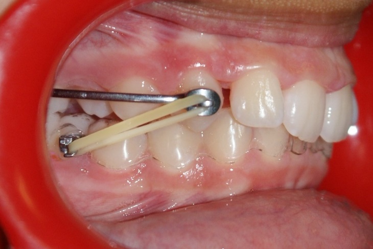teeth with appliance