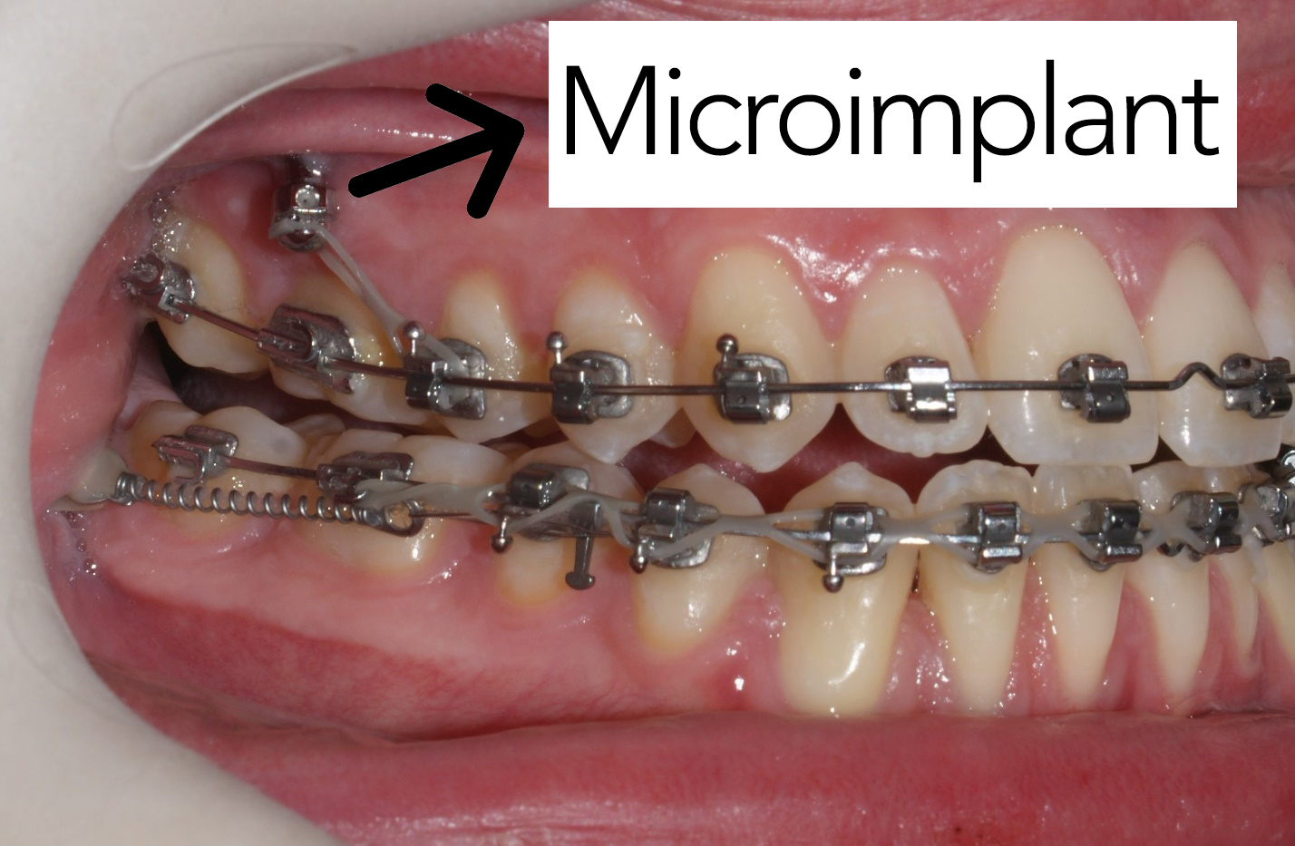 teeth with microimplant