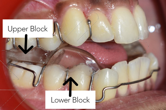 teeth with twin block apparatus